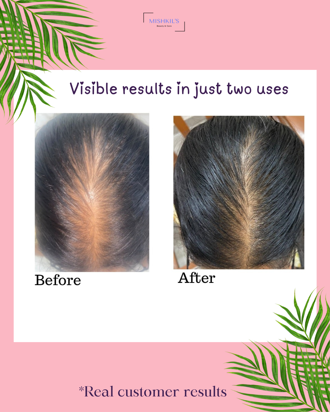 Restore Hair Growth Serum | Redensyl, Anagain, Saw Palmetto & Rosemary Oil | For Hair Regrowth, Bald Patches, Thicker & Fuller Hair | 10 ml